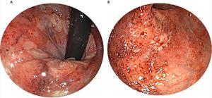 Colonoscopia. A)Se observa zona eritematosa, con erosión y presencia de úlceras superficiales friables en la mucosa del recto. B)Unión rectosigmoidea.