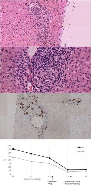 Histological and biochemical findings. (A, B) H&E stain low-magnification (×20 and ×40 respectively) shows lymphoplasmacytic portal infiltrate with focal disruption of the limiting plate. No evidence was found of histologic cholestasis, fibrosis or iron deposit. (C) Immunohistochemical study of plasma cells expressing CD38. (D) Biochemical trend of plasma ALT and AST over time.