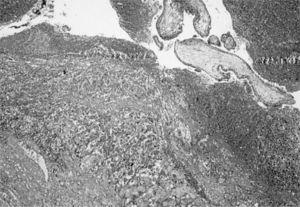 Sección ovárica donde se muestra cuerpo lúteo gravídico, con áreas hemorrágicas e invadido por vellosidades coriales (HE, × 4).