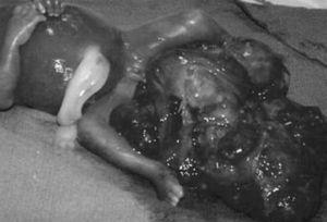 Teratoma sacrococcígeo fetal.