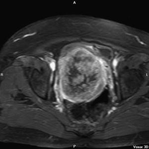 RMN: radiología magnética nuclear (plano radiológico INPHASE+CTE axial con contraste). La tumoración del cérvix.