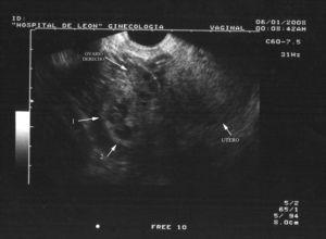 Ecografía transvaginal. Útero vacío, adyacente al ovario derecho, masa de 6×5×5cm, con dos sacos gestacionales independientes (flechas 1 y 2) con un polo embrionario en el interior de cada uno.