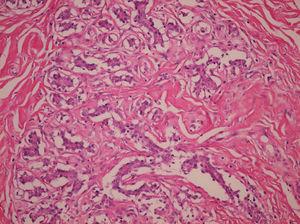 Estudio histológico de fibroadenoma gigante-hiperplasia lobulillar.