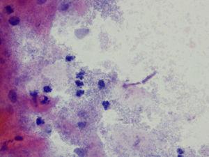 Citología (Papanicolaou, x40). Tricomonas, hongos y vaginosis bacteriana.