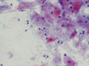 Citología (Papanicolaou, x20). Tricomonas, hongos y vaginosis bacteriana.