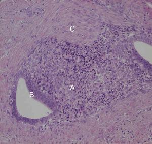 Histología del nódulo umbilical con tinción hematoxilina-eosina de aumento 20X en la que se objetivan células endometriales (A) y glándulas de endometrio (B) junto a tejido fibrótico (C) de la región umbilical.