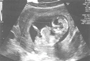 Onfalocele fetal en semana 12 de gestación.