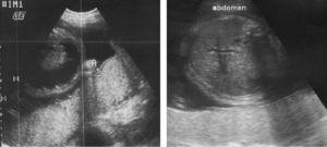 Imágenes ultrasonográficas al mismo nivel (abdomen). Izquierda: unos días antes de la transfusión. Derecha: 2 días después de la transfusión.