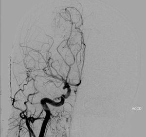 Angiografía por sustracción digital carotidea derecha en proyección AP: aneurisma de la arteria comunicante posterior derecha. Existen signos indirectos de efecto de masa a nivel silviano derecho.