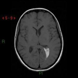 RNM cerebral, imagen axial potenciada en T1: hemorragia subaguda intraventricular.