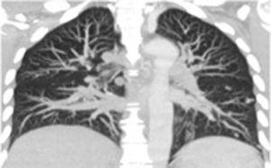 Imagen de TAC (corte coronal). Múltiples nódulos pulmonares.