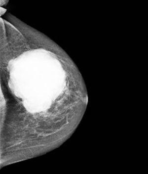 Mamografía de mama izquierda en proyección craneocaudal.