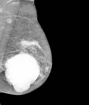 Mamografía de mama izquierda en proyección oblícua-medio-lateral.