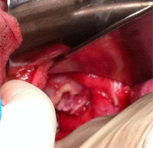 Caso 1. Defecto de vagina visto por vía abdominal.