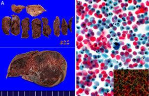 A) Imagen macroscópica de placenta corioamniótica (de 500 g de peso y de 12 × 9 × 3 cm) junto a membranas placentarias y porción de cordón umbilical (10X). B) Frotis de sangre obtenida por impronta directa de la pulpa placentaria (tinción Papanicolaou). Presencia de pigmento intraeritrocitario, que adopta un carácter de birrefringencia a la observación con luz polarizada (4X).