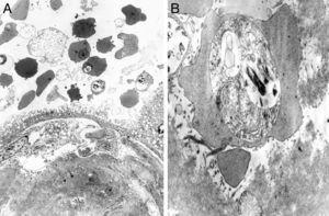 A y B) Imágenes ultraestructurales (a partir de material incluido en parafina) de hematíes maternos parasitados por Plasmodium falciparum en distintos estadios madurativos.