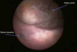 Imagen obtenida durante la histeroscopia quirúrgica, en la que se aprecia pólipo corial en la cara anterior y el fondo uterino, además del ostium derecho.