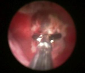 Histeroscopia de extracción de un nódulo de 1cm, descrito en la figura anterior, en el fondo uterino.