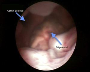 Histeroscopia de nódulo, descrito en la imagen anterior, resecado (originalmente dependía de la cara anterior uterina).