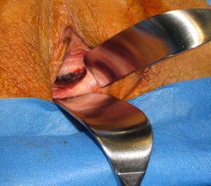 Lesión pigmentaria a nivel vulvar.