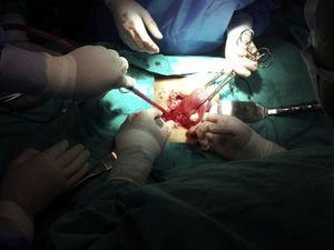 Saco gestacional en cara anterior del útero hacia cicatriz de cesárea previa.