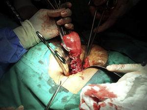 Extracción de pieza quirúrgica debido a sangrado incontrolable.