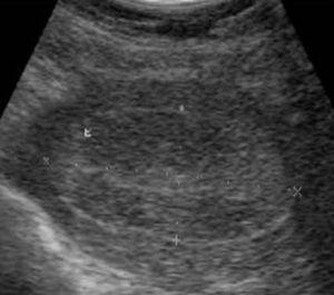 Útero de contorno regular, miometrio homogéneo; engrosamiento endometrial de 21,5 mm.