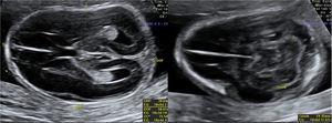 Hipomineralización de la calota fetal.