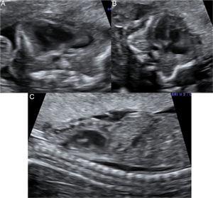 A y B) Corte axial del tórax fetal, se visualiza un tórax pequeño con caja torácica estrecha y corazón de tamaño normal pero que impresiona de mayor tamaño por lo que se diagnostica de hipoplasia torácica con cardiomegalia relativa. C) Corte longitudinal del tórax fetal. Se objetiva un tórax pequeño en relación con el abdomen fetal.