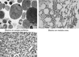 El diagnóstico se confirmó por medio de la reacción de inmunohistoquímica: blastos en sangre periférica y blastos en médula ósea.