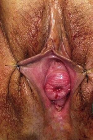 Metástasis vaginal de carcinoma urotelial.