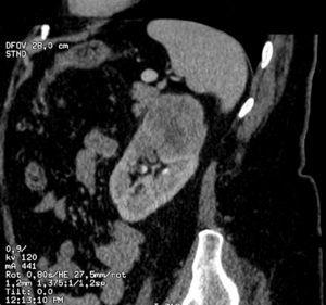 Tumor urotelial del riñón izquierdo.