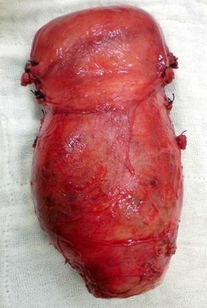 Útero extraído mediante histerectomía total abdominal. Fuente: Archivo del Hospital Provincial General Docente de Riobamba.