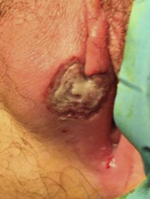 Úlcera genital de bordes irregulares y centro fibrinoso sugestiva de úlcera de Lipschütz.