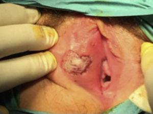 Úlcera genital de bordes irregulares y centro fibrinoso sugestiva de úlcera de Lipschütz.