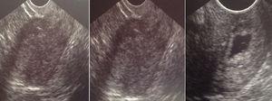 Imágenes ecográficas en las que se observa engrosamiento endometrial a nivel uterino y presencia de saco gestacional con vesícula vitelina en canal endocervical.