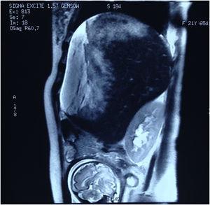 Resonancia magnética en la que se evidencia la presencia de hematoma hepático subcapsular.