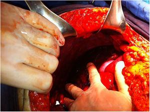Fotografía transquirúrgica en la que se observa la presencia importante de hemoperitoneo.