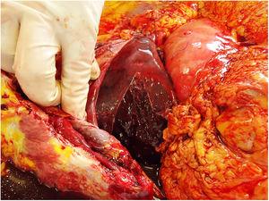 Fotografía transquirúrgica. Se observa el hematoma subcapsular contenido, sin datos de sangrado activo.