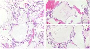 Anatomía patológica placenta: vellosidades coriónicas con cambios hidrópicos y proliferación de trofoblasto, compatible con mola hidatiforme completa.