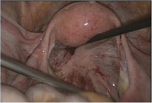 Imagen de la primera laparoscopia donde se puede apreciar un aparato genital interno normal.