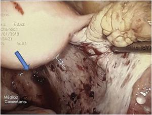 Localización de la lesión a nivel de saco de Douglas (flecha azul) sobre el peritoneo que recubre el recto. Se puede apreciar el sangrado en sábana de la lesión.