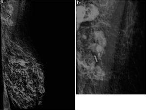 Imagen de mamografía que muestra semilla de I125 colocada junto a clip de marcaje ganglionar previo.