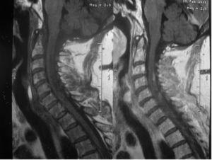 Resonancia magnética de columna cervical. Lesión desmielinizante medular.