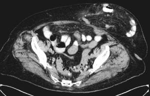 TC abdominal, imagen axial: hernia de pared abdominal anterior con contenido de asas de intestino delgado y signos inflamatorios de la grasa mesentérica.