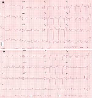 a) Primer electrocardiograma registrado en el Servicio de Urgencias; b) electrocardiograma realizado tras varias horas de ingreso.