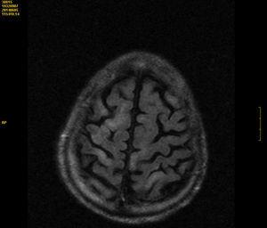 RM cerebral realizada 72 horas desde el inicio de los síntomas: se visualizan áreas de restricción en secuencia de difusión en los giros corticales de ambos lóbulos fronto-parietales, sugestivos de infartos venosos.
