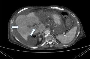 Imagen de trombosis de la vena mesentérica superior y de la porta con cavernomatosis. Área isquémica extensa hepática y presencia de abundante líquido libre intraperitoneal.