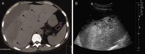 Abdominal computed tomography (A) and liver ultrasound (B) revealing a large subcapsular liver hematoma (13.8cm×3.9cm) (arrows) causing compression of the underlying liver parenchyma. No source for the hemorrhage was evident.