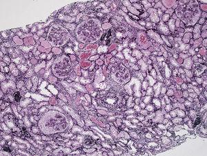 Biopsia renal. Tinción con metenamina-plata. Se observan glomérulos con aumento de la celularidad, tanto a nivel endocapilar como con formación de semilunas extracapilares.